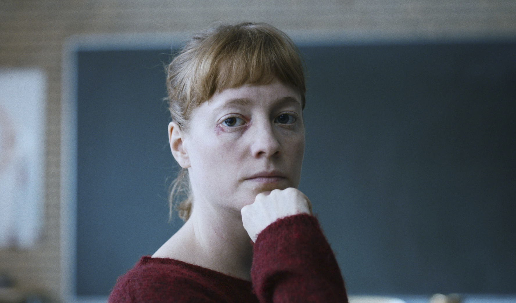 A white woman with red hair pulled back into a ponytail rests her chin on her hand. She has a slight black eye.