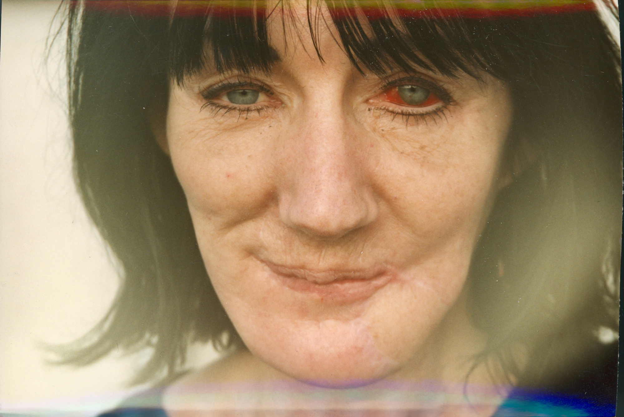 woman with one bloodshot eye and scar at corner of mouth